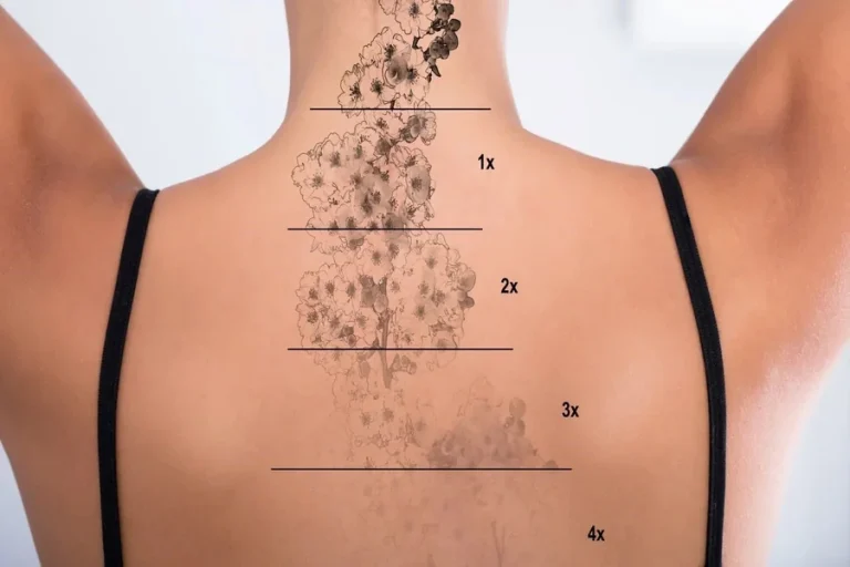 The Ultimate Guide to Safe and Effective Tattoo Removal The Ultimate Guide to Safe and Effective Tattoo Removal